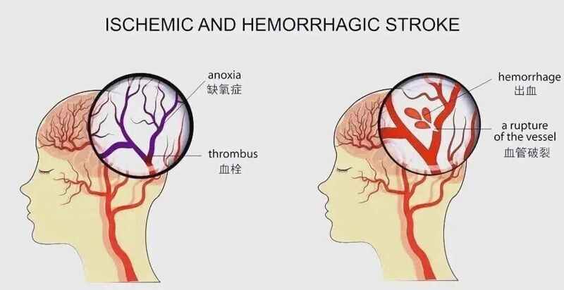 脑卒中康复难？哈佛新研究：干细胞协调免疫 助力大脑修复